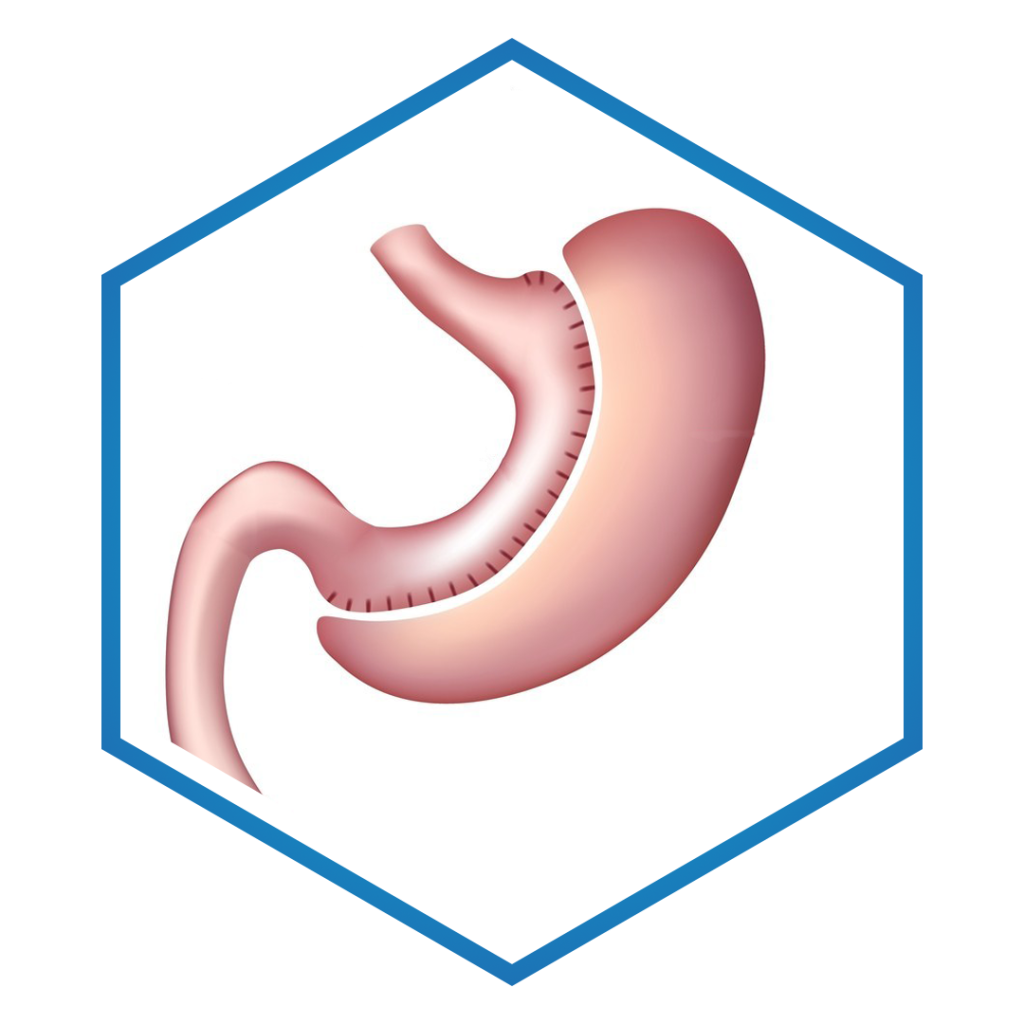 Gastric sleeve Medical tourism in Turkey