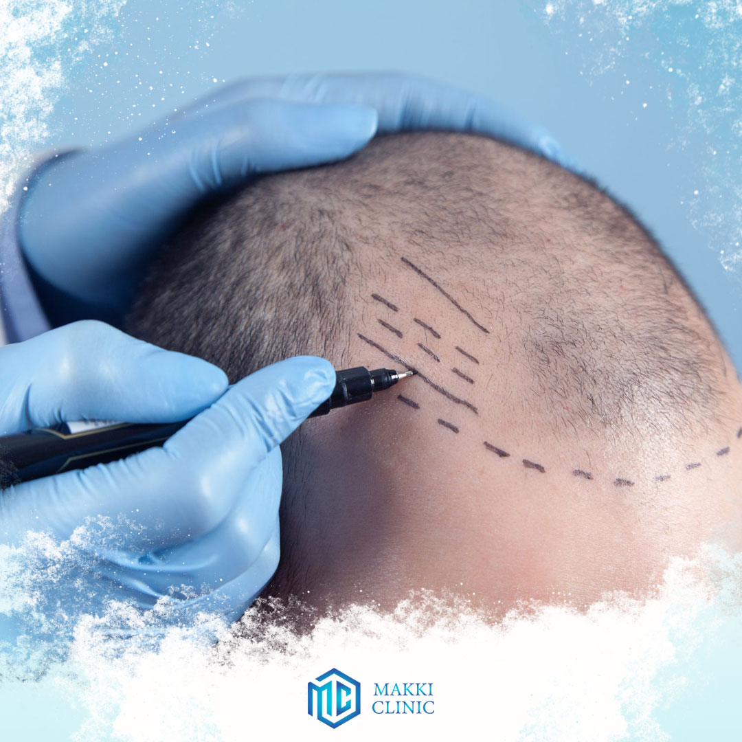 Key Factors for the correct preservation of hair follicles during hair transplantation