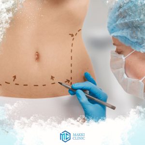 Types of tummy tuck operations in Turkey