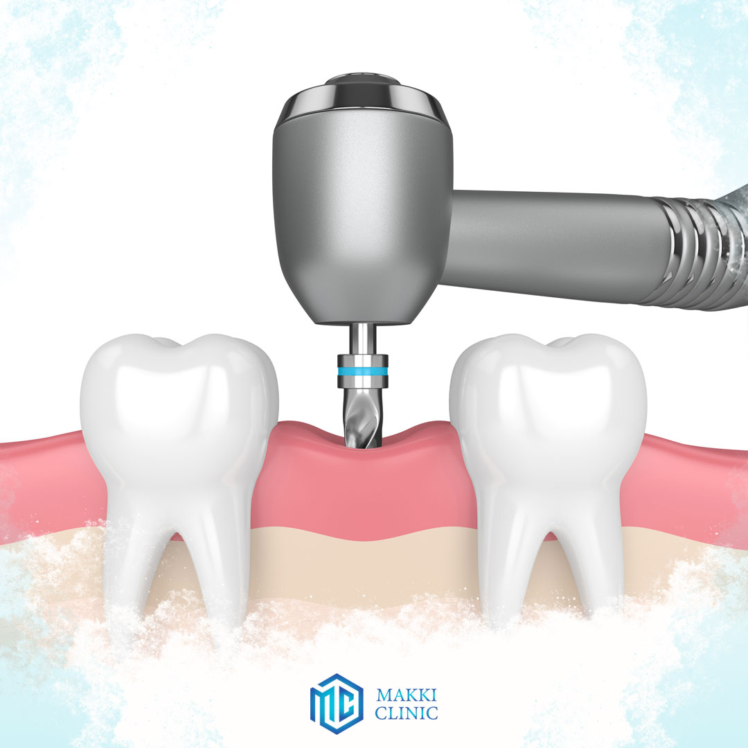 What is the cost of dental implants in Turkey